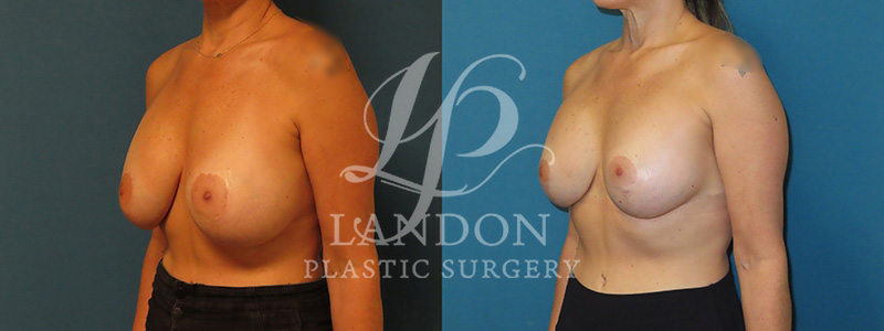 Breast Implant Exchange Before & After Image