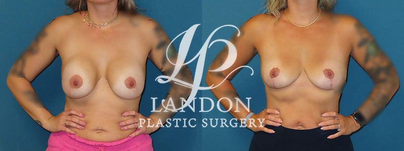 Breast Implant Removal Before & After Image