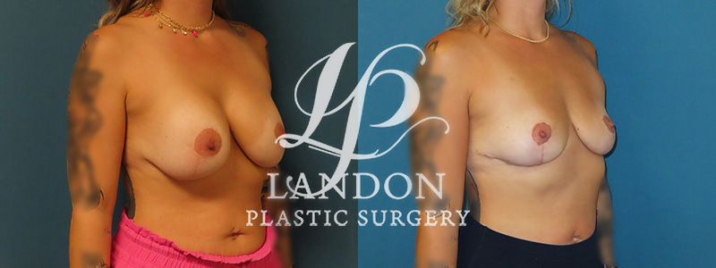 Breast Implant Removal Before & After Image