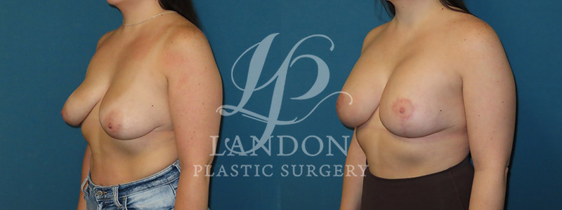 Breast Lift Before & After Image