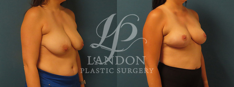 Breast Lift Before & After Image