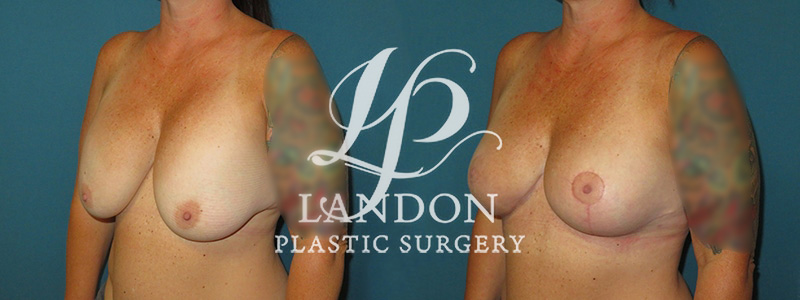 Breast Lift Before & After Image