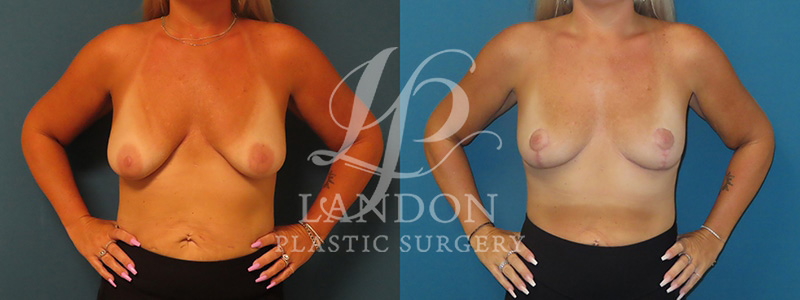 Breast Lift Before & After Image