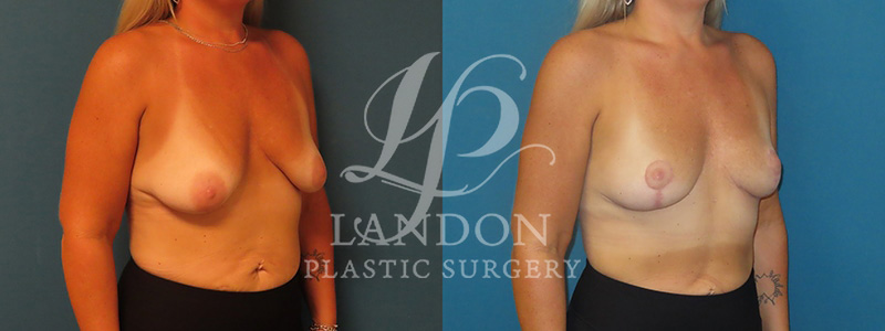 Breast Lift Before & After Image