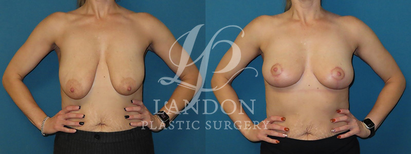 Breast Lift Before & After Image