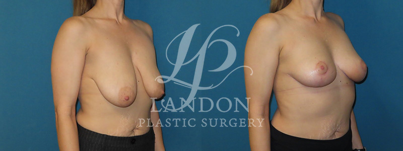 Breast Lift Before & After Image