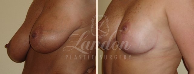 Breast Lift Before & After Image