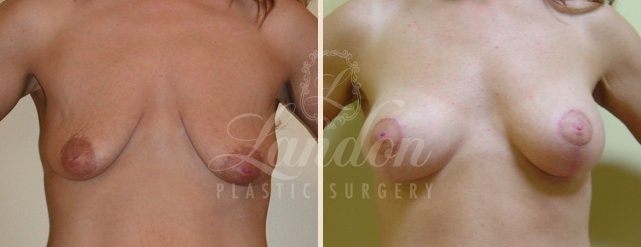 Breast Lift Before & After Image