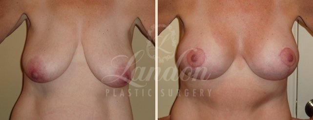 Breast Lift Before & After Image