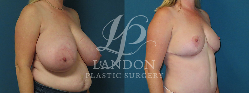 Breast Reduction Before & After Image