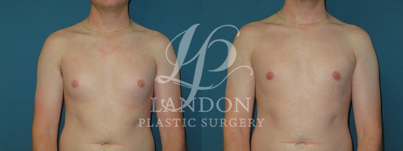 Breast Reduction Before & After Image
