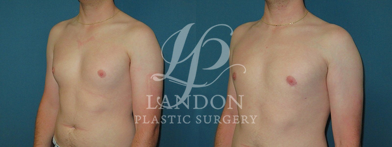 Breast Reduction Before & After Image
