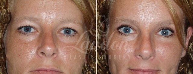Eyelid Surgery Before & After Image