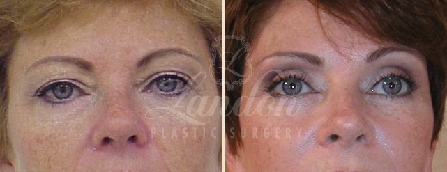 Eyelid Surgery Before & After Image