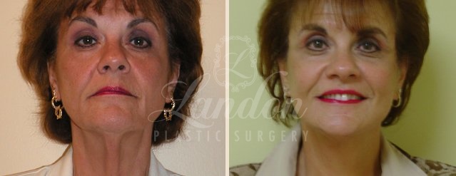 Face & Neck Lift Before & After Image