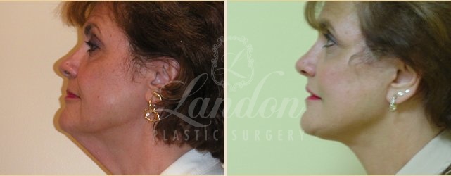 Face & Neck Lift Before & After Image