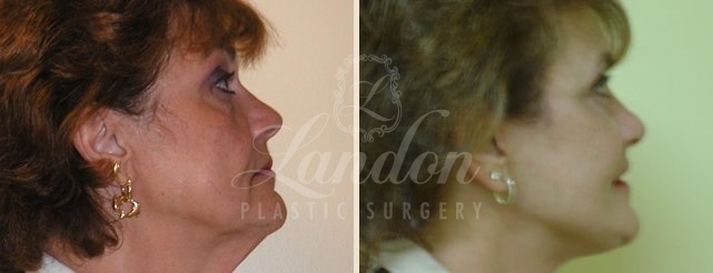 Face & Neck Lift Before & After Image