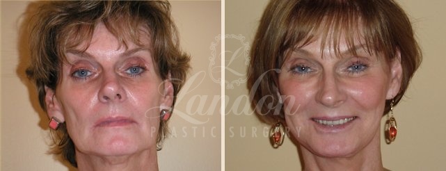 Face & Neck Lift Before & After Image