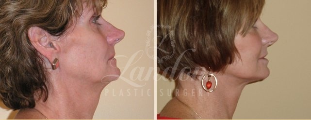Face & Neck Lift Before & After Image