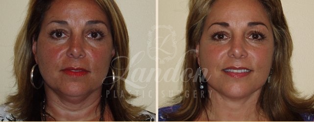 Face & Neck Lift Before & After Image