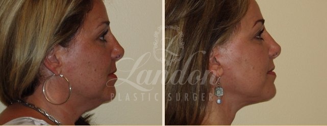 Face & Neck Lift Before & After Image