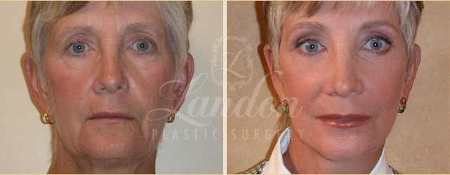 Face & Neck Lift Before & After Image