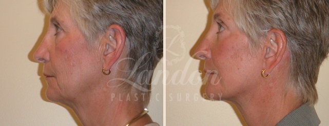 Face & Neck Lift Before & After Image