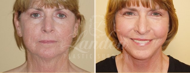 Face & Neck Lift Before & After Image