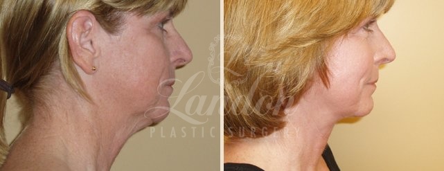 Face & Neck Lift Before & After Image