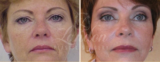 Face & Neck Lift Before & After Image