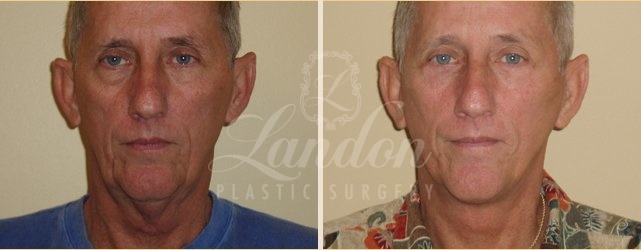 Face & Neck Lift Before & After Image