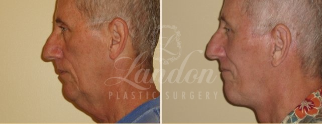 Face & Neck Lift Before & After Image