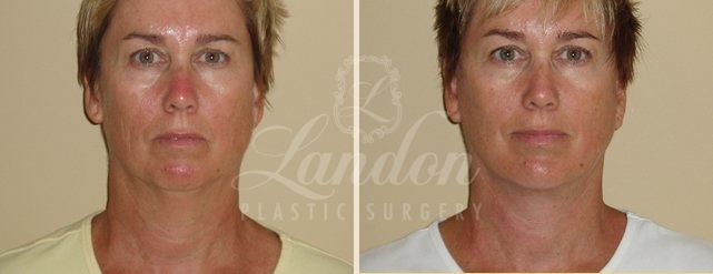 Mini Face Lift Before & After Image