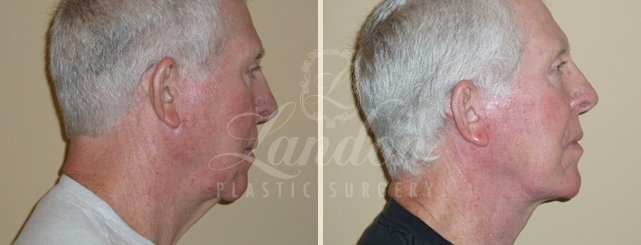 Mini Face Lift Before & After Image